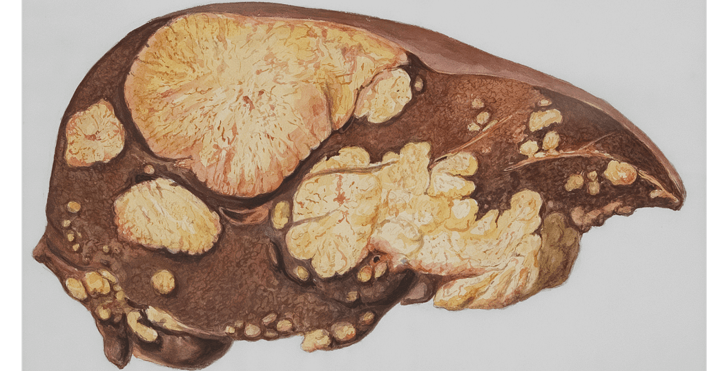Liver Failure Symptoms : शराब पीने वालों के लिए बड़ी चेतावनी — ये 3 लक्षण दिखें तो संभल जाएं 1 Liver Failure Symptoms